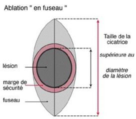 Exérèse