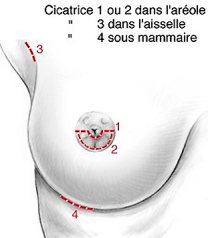 Incisions pour implant