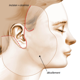 Incision Lifting cervico facial