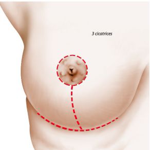 Réduction mammaire 3 cicatrices