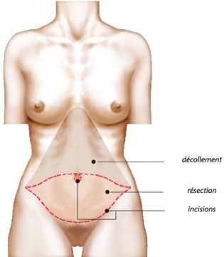 Abdominoplastie dessins