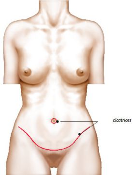 Abdominoplastie Cicatrice