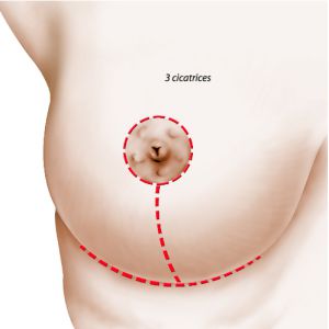 3 cicatrices en T