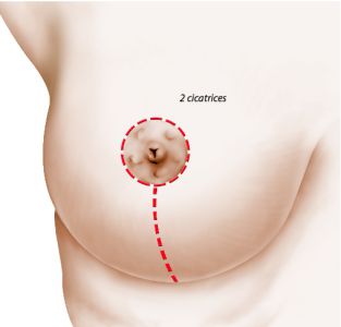2 cicatrices verticale