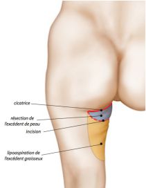 Cruroplastie
