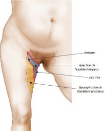 Cicatrice en T
