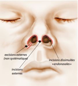 Incisions Nez