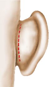 Incision Oreille